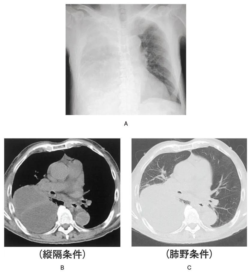 第112回 E問題 第44問の問題画像